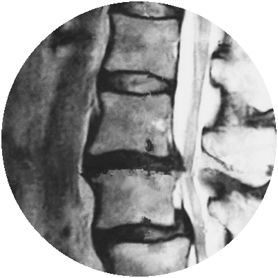 変形性腰椎症